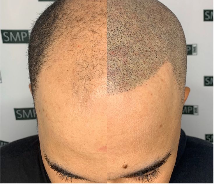 Tot ce trebuie să știi despre micropigmentare - scalpul tău merită asta!