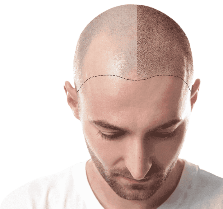 micropigmentarea scalpului înainte și după.